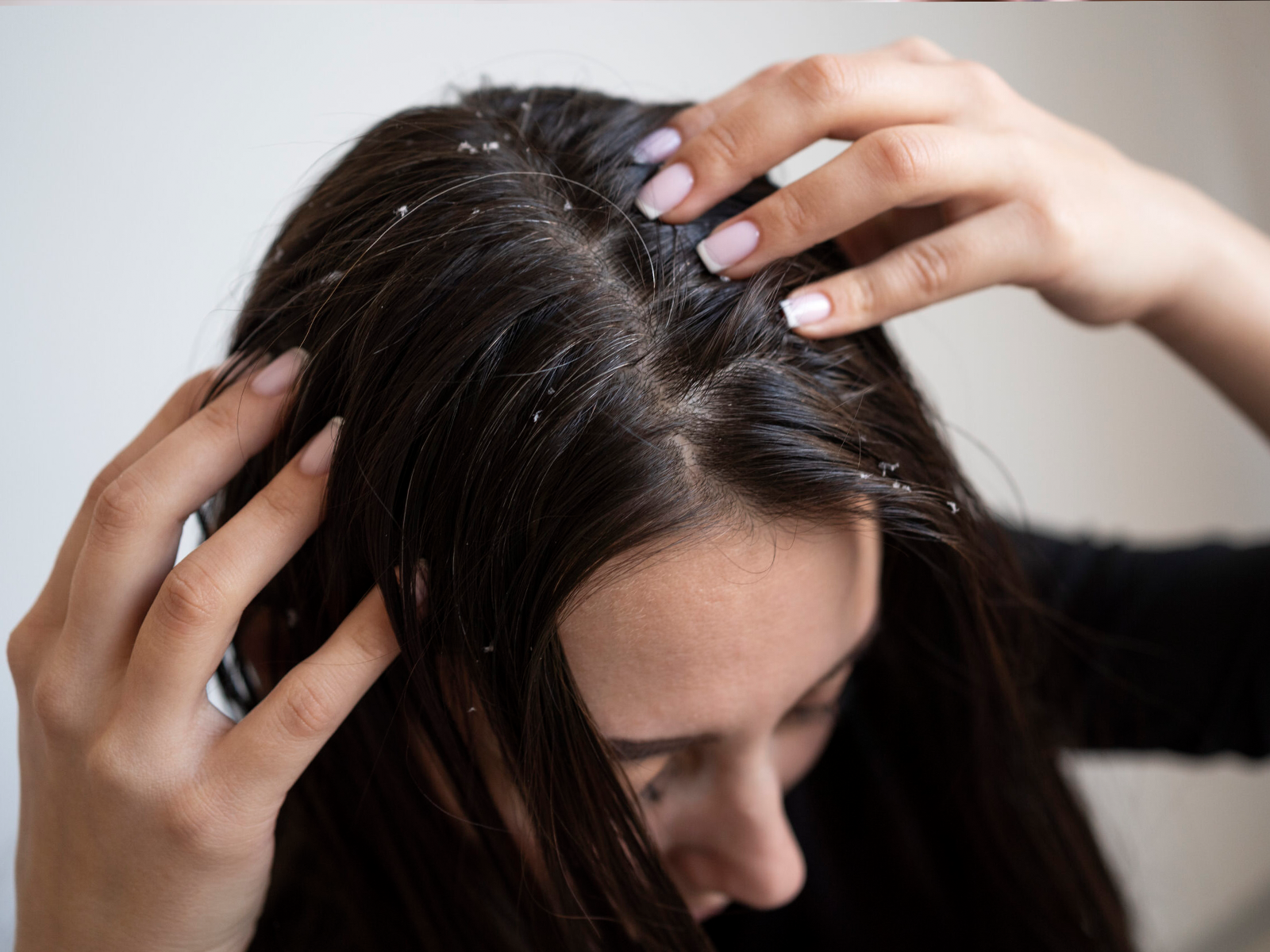 Dandruff Treatment